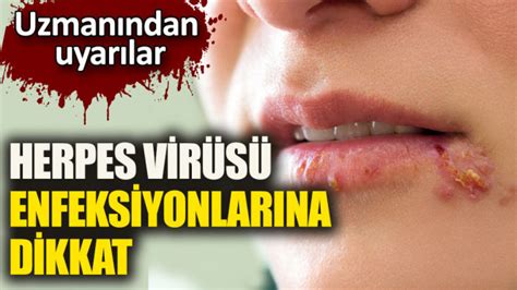 hermes virüsü|herpes virüsü tedavisi.